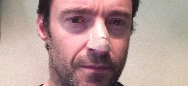 Hugh Jackman Hugh Jackman anuncia que tiene cáncer de piel en la nariz